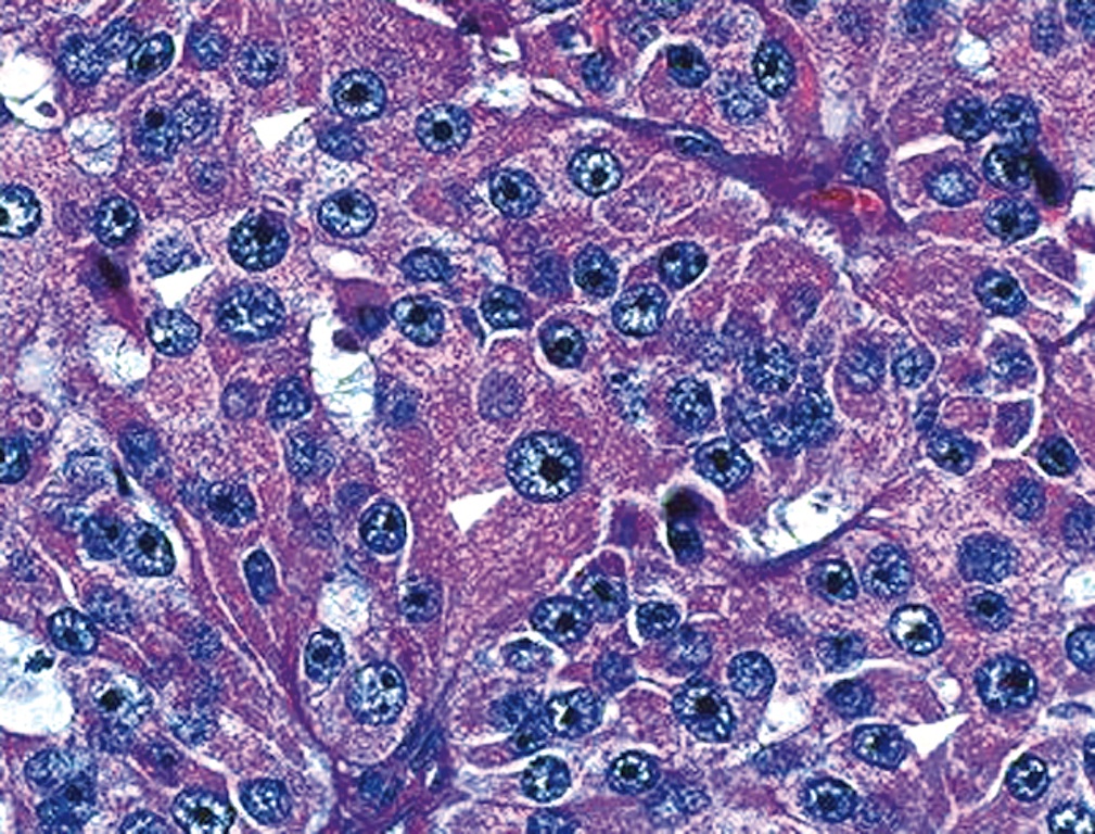 Pathology Outlines Oncocytic (Hürthle cell) tumors